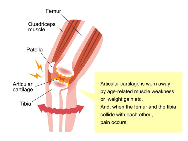 膝关节疼痛 骨关节炎 膝关节关节病 的发病机制及原因 平面插图 — 图库矢量图片