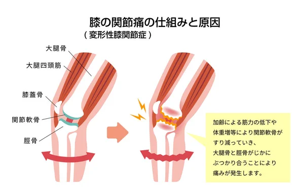 Mechanismus Und Ursachen Von Kniegelenkschmerzen Gonarthrose Arthrose Arthrose Des Knies — Stockvektor