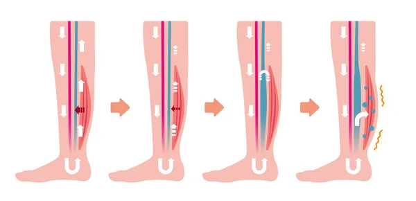 다리가 부어오르는 평면의 — 스톡 벡터