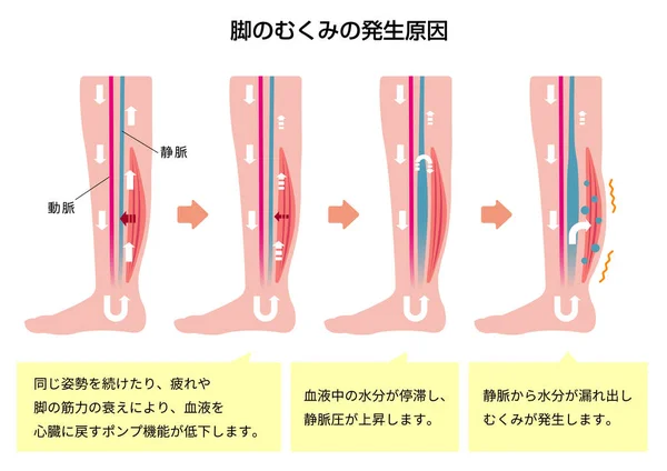 脚の腫れ の原因 日本語 — ストックベクタ
