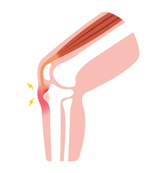 Illustrazione Della Malattia Osgood Schlatter Malattia Delle Articolazioni Del Ginocchio — Vettoriale Stock