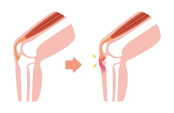 Osgood Schlatter Disease Knee Joint Disease Illustration — Stock Vector