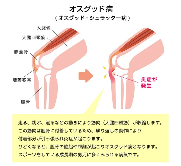 Osgood Schlatter Krankheit Kniegelenkserkrankung Illustration Japanisch — Stockvektor