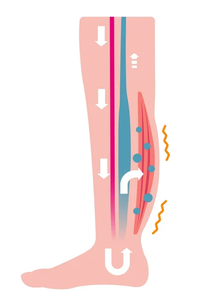 Cause Gonflement Œdème Des Jambes Des Fuites Eau Des Veines — Image vectorielle