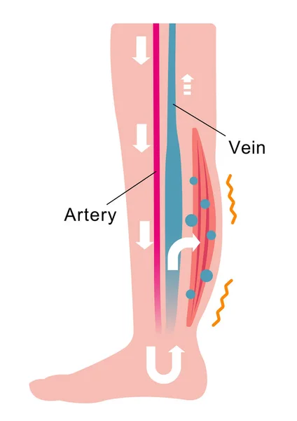 다리가 부어오르는 혈관에서 부어오르기 평면의 — 스톡 벡터