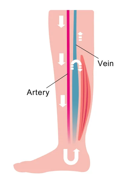 Causa Hinchazón Edema Las Piernas Agua Sangre Estanca Presión Venosa — Vector de stock