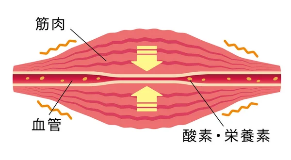 血管が圧迫された 筋肉や器の平面図 — ストックベクタ