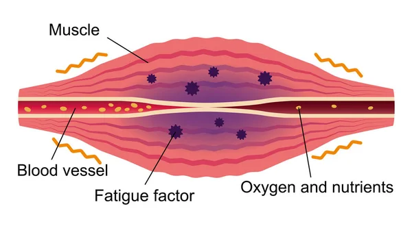 Trötthetsfaktorer Ackumuleras Platt Illustration Muskler Och Kärl — Stock vektor