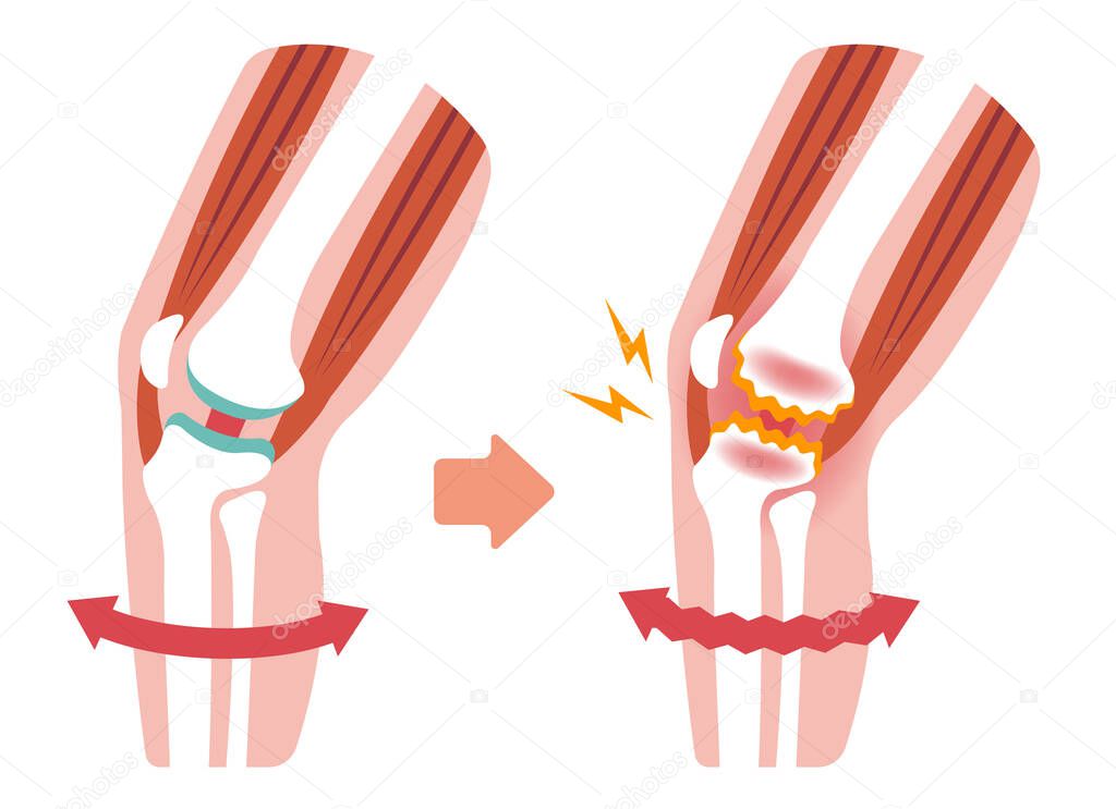 Mechanism and causes of knee joint pain (gonarthrosis / osteoarthritis / arthrosis of knee ) . flat illustration.