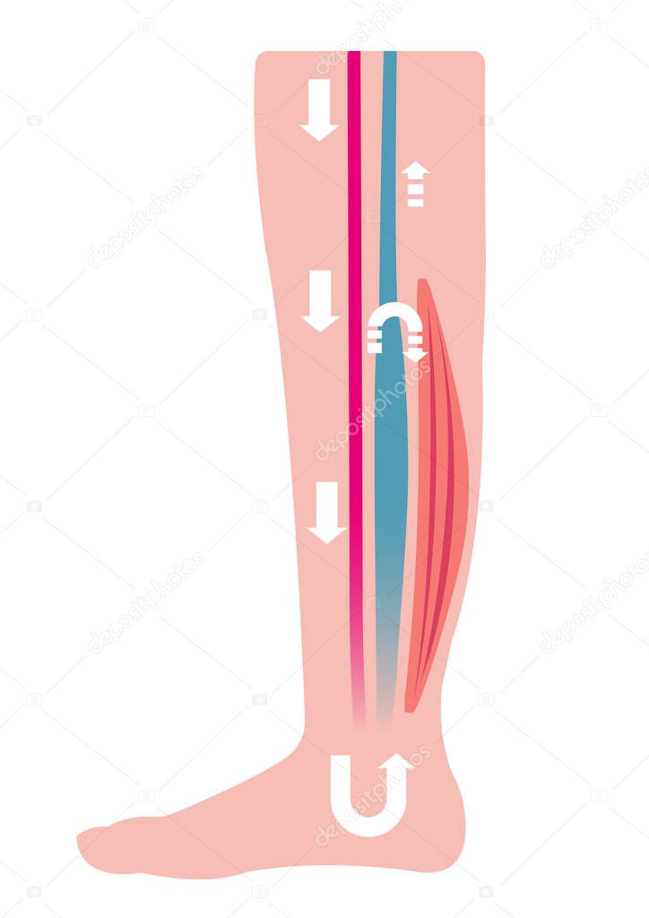 Cause of swelling(edema) of the legs. Water in the blood stagnates and venous pressure rises. flat illustration.