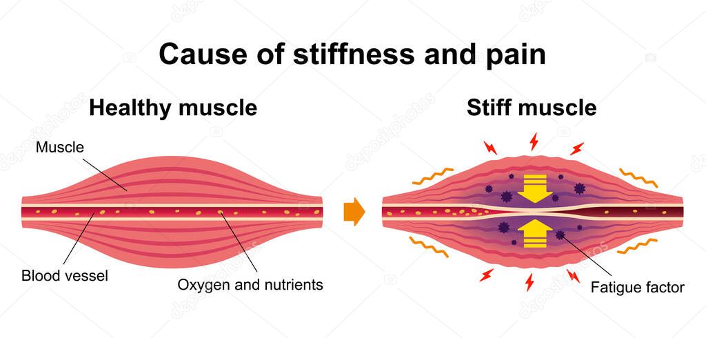 Cause of muscle's stiffness and pain illustration