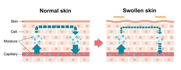 正常な皮膚と腫れた皮膚の比較図 — ストックベクタ