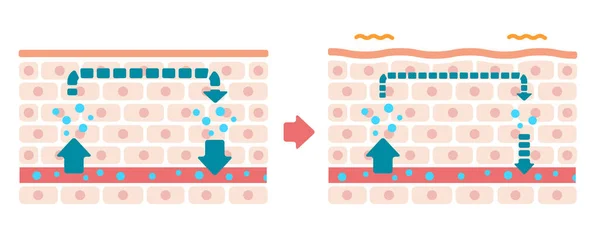 Ilustración Comparativa Piel Normal Hinchada — Vector de stock