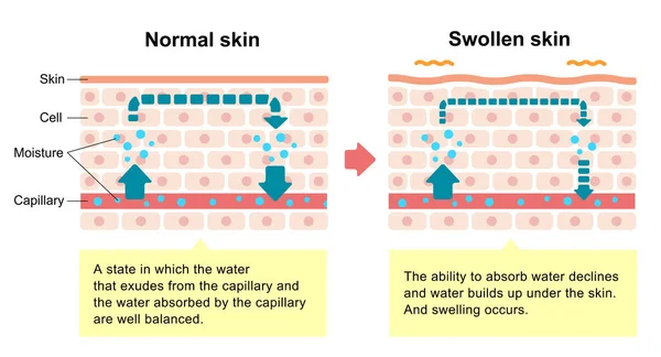 正常な皮膚と腫れた皮膚の比較図 — ストックベクタ