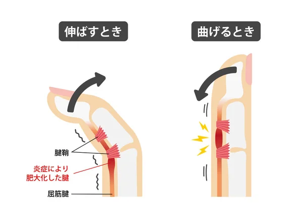 トリガー指の原因と症状イラスト 日本語 — ストックベクタ