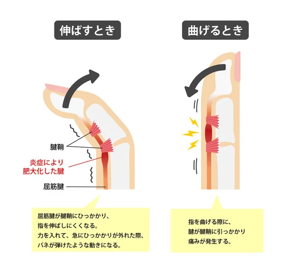 トリガー指の原因と症状イラスト 日本語 — ストックベクタ