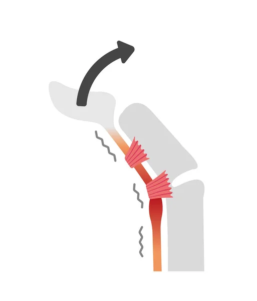 Auslöser Für Ursachen Und Symptome Des Fingers Illustration Kein Text — Stockvektor