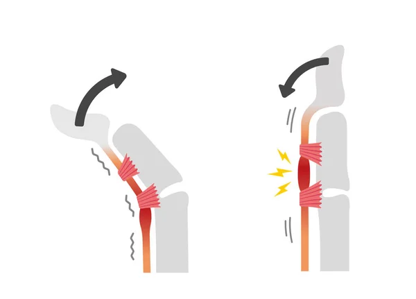 Causas Síntomas Del Dedo Desencadenante Ilustración Sin Texto — Vector de stock