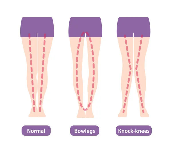脚の角度や膝のイラストの違いタイプ — ストックベクタ