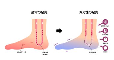 Comparison illustration of normal foot and cold foot ( sensitivity to cold, cold toes) / Japanese clipart