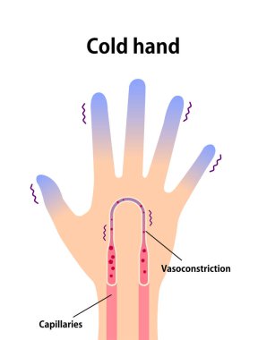 Soğuk el kan dolaşımı örnekleme (soğuk, soğuk parmak uçlarına duyarlılık)