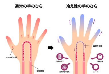 Normal el ve soğuk elin karşılaştırılması (soğuk, soğuk parmak uçlarına duyarlılık) / Japonca