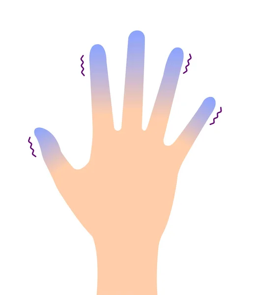 Ilustração Circulação Sanguínea Mão Fria Sensibilidade Frio Pontas Dos Dedos —  Vetores de Stock