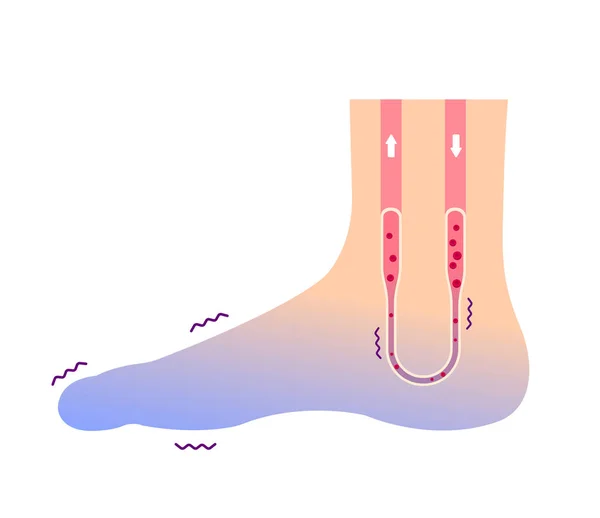 Illustrazione Della Circolazione Sanguigna Del Piede Freddo Sensibilità Freddo Dita — Vettoriale Stock