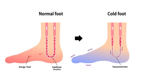 Normal Ayak Soğuk Ayakların Karşılaştırılması Soğuk Soğuk Ayak Parmaklarına Duyarlılık — Stok Vektör