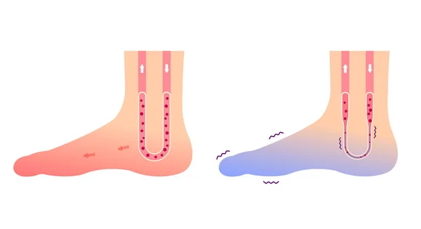 Ilustración Comparativa Pie Normal Pie Frío Sensibilidad Los Pies Fríos — Vector de stock