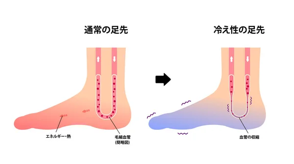 通常の足と冷たい足の比較図 寒さに対する感度 日本語 — ストックベクタ