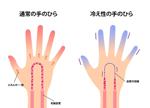 Normal Soğuk Elin Karşılaştırılması Soğuk Soğuk Parmak Uçlarına Duyarlılık Japonca — Stok Vektör