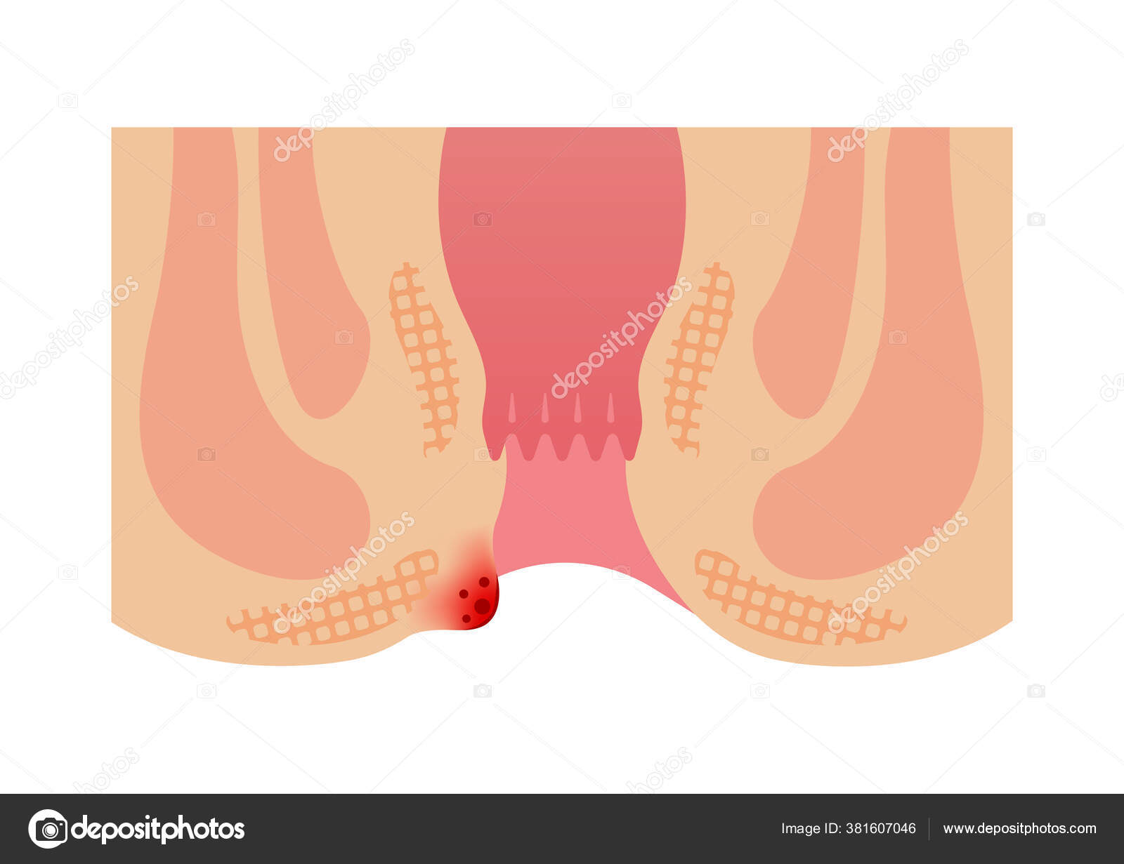 750+ Hemorroide Stock Illustrations, graphiques vectoriels libre de droits  et Clip Art - iStock