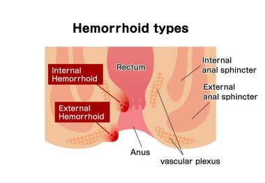 Hemoroit düz vektör çizimi türleri