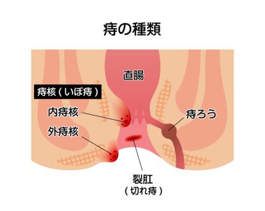 Hemoroit düz vektör illüstrasyonunun türleri (Japonca )