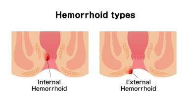 Hemoroit düz vektör çizimi türleri