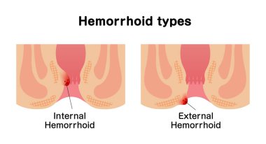 Types of Hemorrhoid flat vector illustration clipart