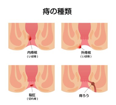 Hemoroit düz vektör illüstrasyonunun türleri (Japonca)