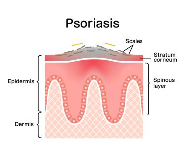 Sedef hastalığının deri / düz vektör illüstrasyonunun kesiti