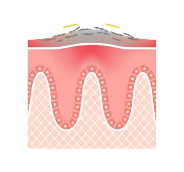 Sedef hastalığının deri / düz vektör illüstrasyonunun kesiti