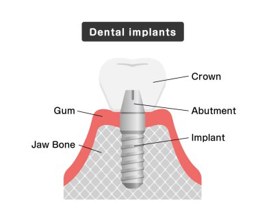 Diş implantı düz vektör çizimi