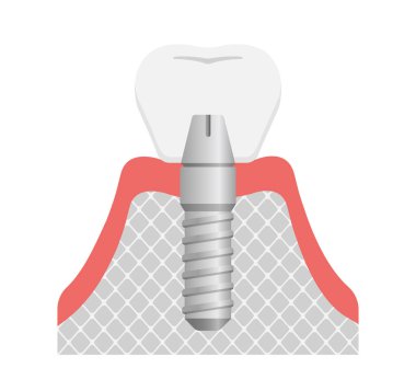 Diş implantı düz vektör çizimi (metin yok)