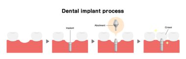Diş implantı düz vektör çizimi 