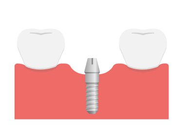 Diş implantı düz vektör illüstrasyonu / Eklenti abutment