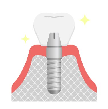 Diş implantı düz vektör çizimi / Yapay dişleri ayarla (taç)