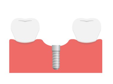 Diş implantı düz vektör çizimi / çene kemiğine implant