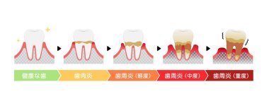 Periodontit hastalığı taşıyıcı illüstrasyonunun aşamaları