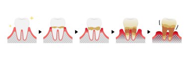 Periodontit hastalığı taşıyıcı illüstrasyonunun aşamaları