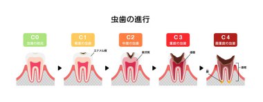 Diş çürüme / düz vektör çiziminin aşamaları (Japonca)