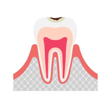 Diş çürüğünün / diş minesinin aşaması